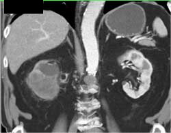 Transitional Cell Cancer (TCC) of Right Kidney - CTisus CT Scan