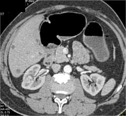 1 Cm Right Renal Cell - Easy to Miss on Arterial Phase - CTisus CT Scan