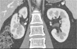 Small Lower Pole Right Renal Cell Carcinoma (RCC) - CTisus CT Scan