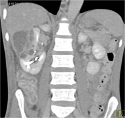 Renal Abscess Simulates A Tumor - CTisus CT Scan
