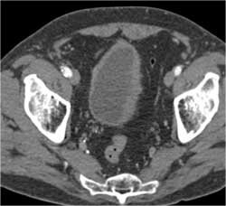 Bladder Cancer - CTisus CT Scan