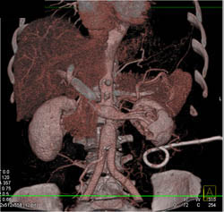 Drain Near Left Kidney - CTisus CT Scan