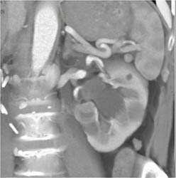 Small Renal Cell Carcinoma (RCC) - CTisus CT Scan