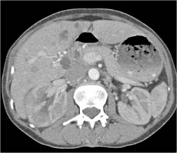 Acute Pyelonephritis - CTisus CT Scan