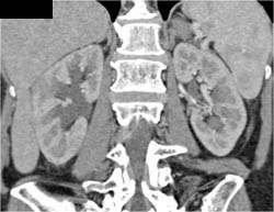 Acute Pyelonephritis - CTisus CT Scan