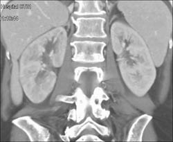 Acute Pyelonephritis - CTisus CT Scan