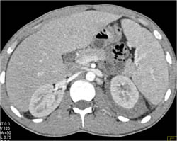 Perirenal Bleed on the Left - CTisus CT Scan