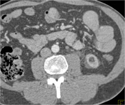 Stone in Left Ureter Obstructs the Kidney - CTisus CT Scan