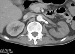 Stent in Left Renal Artery With Poor Function of Left Kidney - CTisus CT Scan