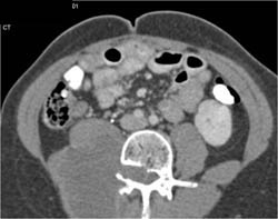 Neurogenic Sarcoma in Patient Previously Treated for Wilms Tumor as A Child - CTisus CT Scan