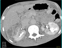 Renal Abscess - CTisus CT Scan