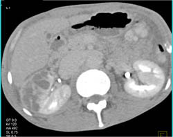 Renal Abscess - CTisus CT Scan