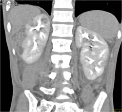 Renal Abscess - CTisus CT Scan