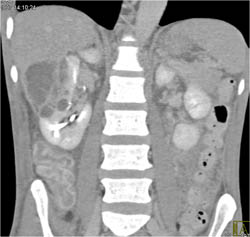 Renal Abscess - CTisus CT Scan