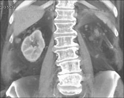 Metastatic Nodules - CTisus CT Scan