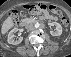 Renal Artery Aneurysm - CTisus CT Scan