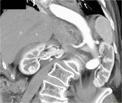 Subtle Right Renal Cell Carcinoma (RCC) - CTisus CT Scan