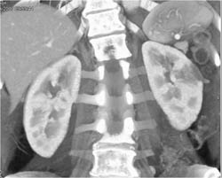 Acute Pyelonephritis - CTisus CT Scan