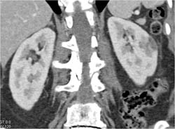 Acute Pyelonephritis - CTisus CT Scan