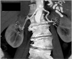 Fibromuscular Dysplasia of the Renal Artery -right - CTisus CT Scan