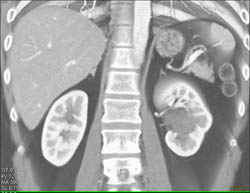 Transitional Cell Cancer (TCC) in Left Kidney - CTisus CT Scan