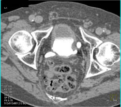 Transitional Cell Cancer (TCC) Bladder With Diverticuli - CTisus CT Scan