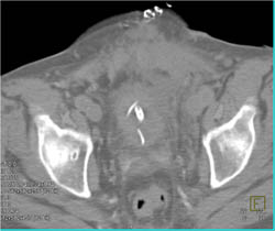 Leak From Bladder at Anastomotic Site for Renal Transplant - CTisus CT Scan