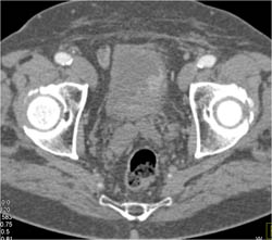 Early Enhancing Bladder Cancer - CTisus CT Scan