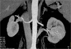 Renal Cell Carcinoma - CTisus CT Scan