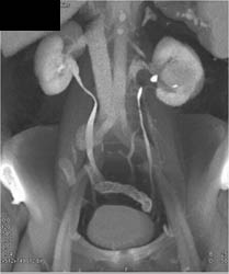 Renal Cell Carcinoma - CTisus CT Scan