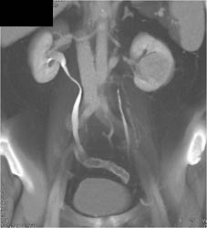 Renal Cell Carcinoma - CTisus CT Scan