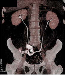 Ileal Loop Following Cystectomy - CTisus CT Scan