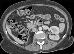 Left Sided Renal Cell Carcinoma (RCC) in Patient With Prior Nephrectomy for Right Rcc - CTisus CT Scan