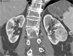 Clear Cell Renal Cell Carcinoma - CTisus CT Scan