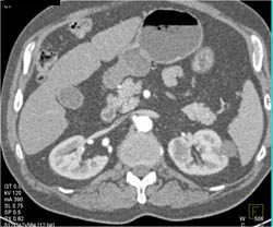 Subtle Left 2 Cm Renal Cell Carcinoma - CTisus CT Scan