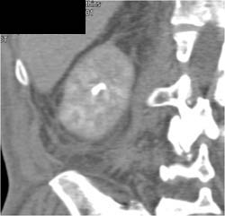 Acute Pyelonephritis - CTisus CT Scan