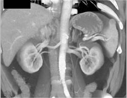 Renal Cell Carcinoma - CTisus CT Scan