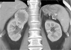 Renal Cell Carcinoma - CTisus CT Scan