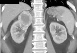 Renal Cell Carcinoma - CTisus CT Scan