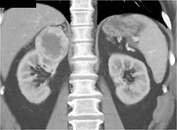 Renal Cell Carcinoma - CTisus CT Scan