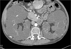 Polycystic Kidney Disease Plus Renal Transplant - CTisus CT Scan