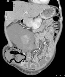 Pneumatosis in Patient With Polycystic Kidney Disease - CTisus CT Scan