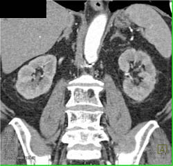 2 Left Renal Arteries - CTisus CT Scan