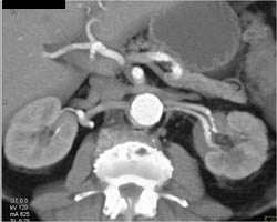 2 Left Renal Arteries - CTisus CT Scan