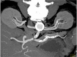 2 Left Renal Arteries - CTisus CT Scan