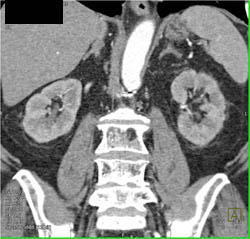 2 Left Renal Arteries - CTisus CT Scan