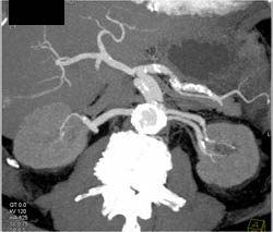 2 Left Renal Arteries - CTisus CT Scan