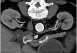 2 Left Renal Arteries - CTisus CT Scan