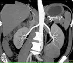 Renal Cell Carcinoma With Vascular Mapping and Multiple Phases - CTisus CT Scan