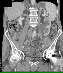 Transitional Cell Carcinoma of the Left Ureter - CTisus CT Scan